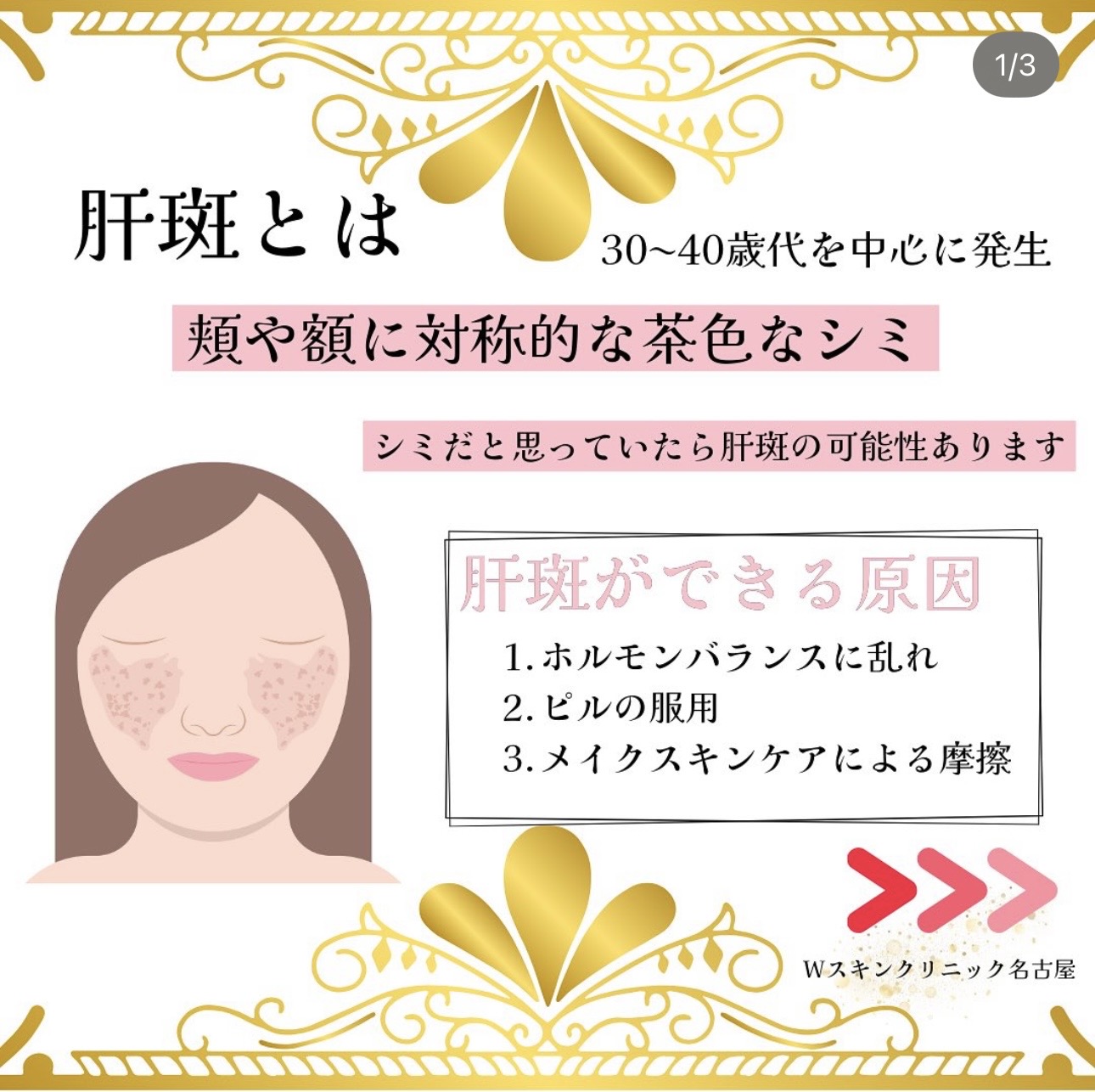 気になるシミだと思ってたら肝斑の可能性あります。名古屋の美容皮膚科スタッフが解説。